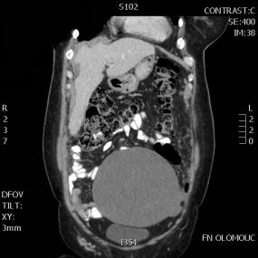 objemný tumor dutiny břišní s karcinomatózou perionea před léčbou